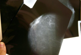 Estudio concluye que un tipo cáncer mama se podría curar sin quimioterapia