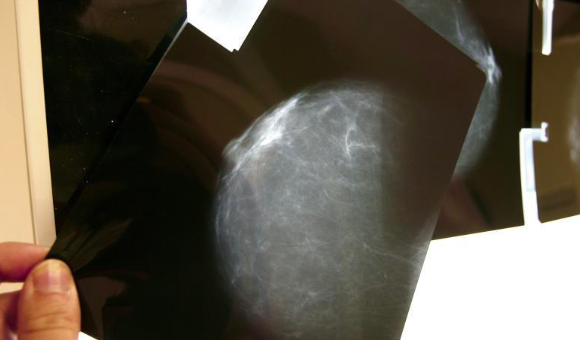 Estudio concluye que un tipo cáncer mama se podría curar sin quimioterapia